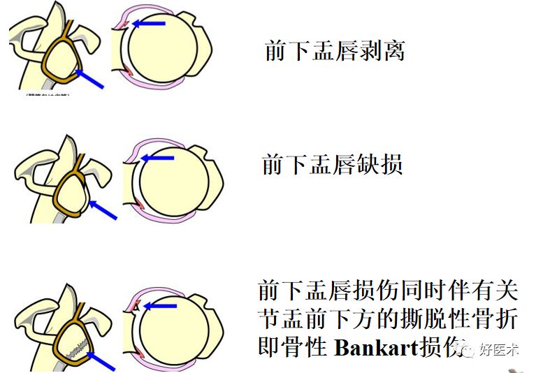 肩关节损伤的影像学诊断-46