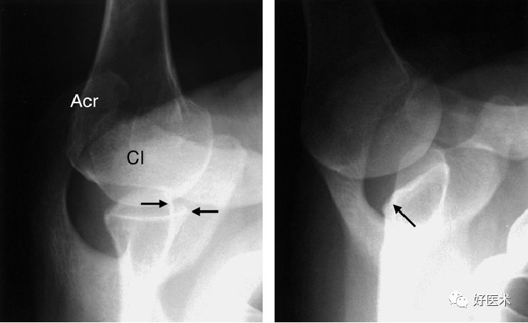肩关节损伤的影像学诊断-17