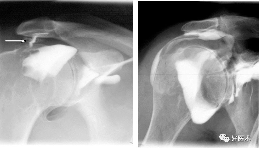 肩关节损伤的影像学诊断-20