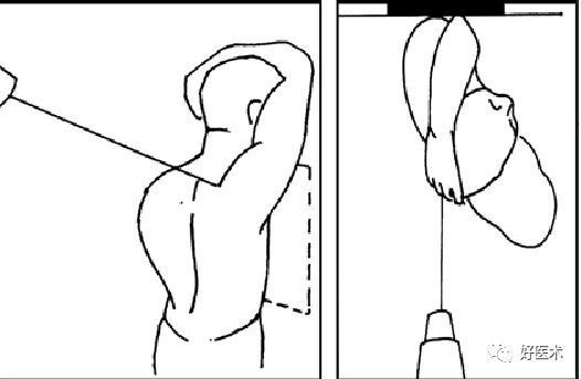 肩关节损伤的影像学诊断-16