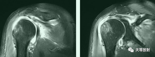 肩关节损伤的影像学诊断-38