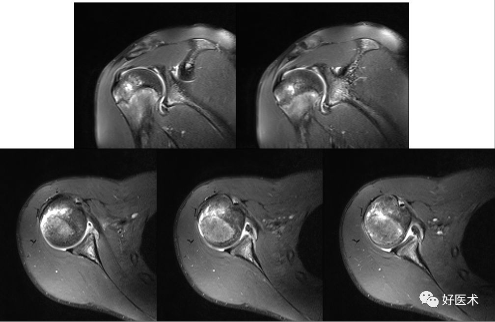 肩关节损伤的影像学诊断-60