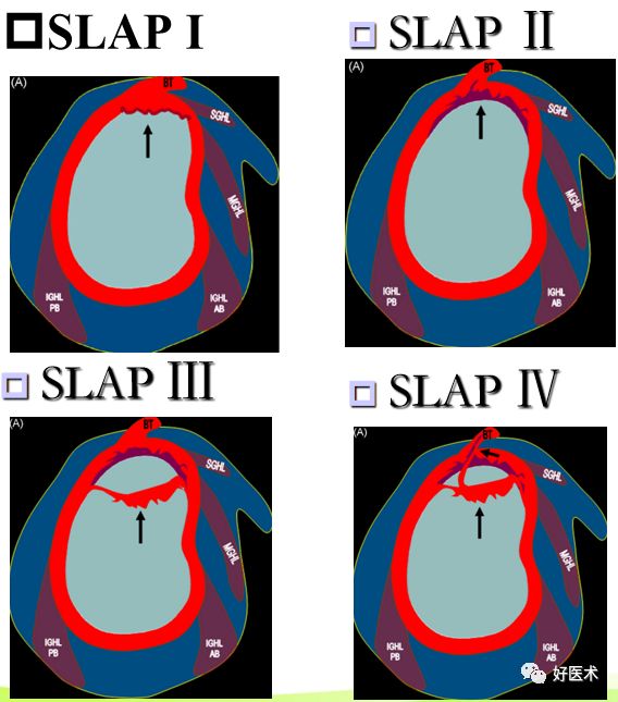 肩关节损伤的影像学诊断-43