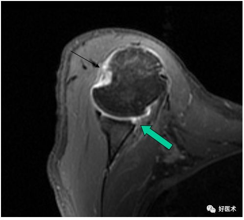 肩关节损伤的影像学诊断-50