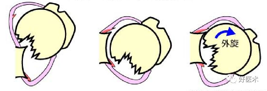 肩关节损伤的影像学诊断-55