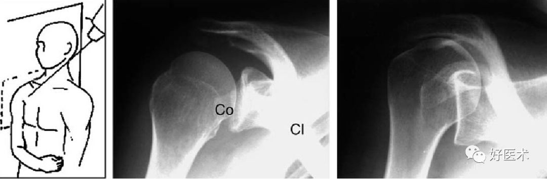 肩关节损伤的影像学诊断-15