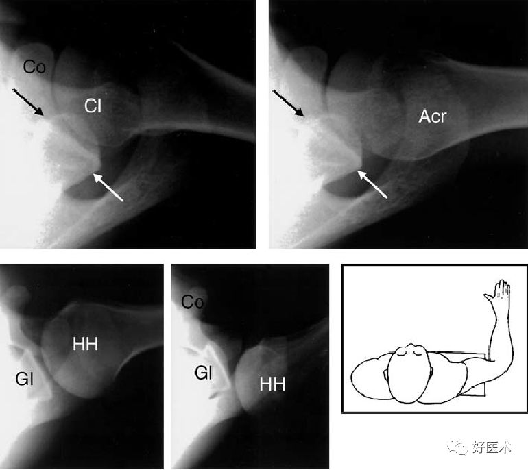 肩关节损伤的影像学诊断-14
