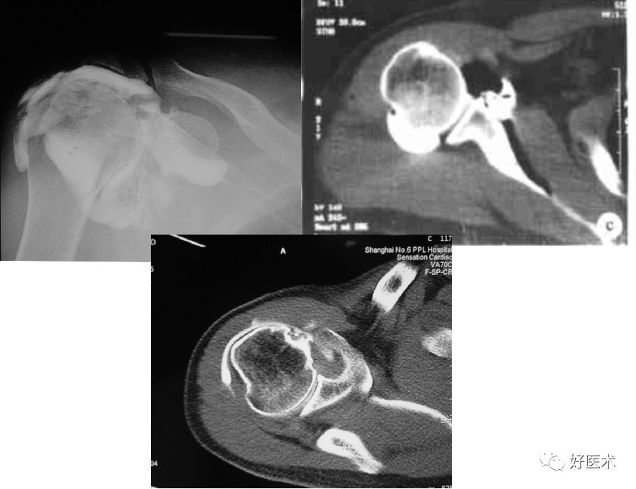 肩关节损伤的影像学诊断-24