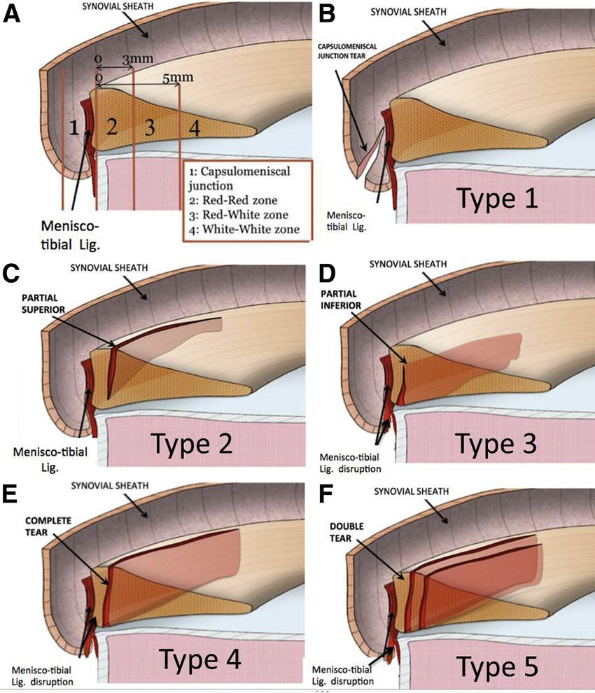 半月板Ramp损伤-2