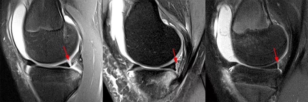 半月板Ramp损伤-7