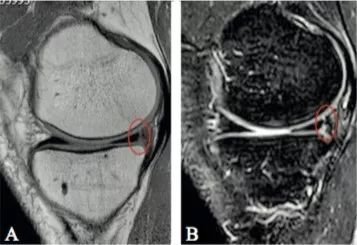 半月板Ramp损伤-6