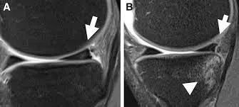 半月板Ramp损伤-3