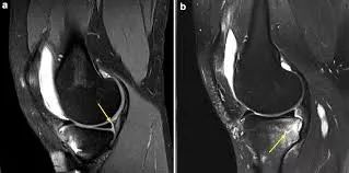 半月板Ramp损伤-5
