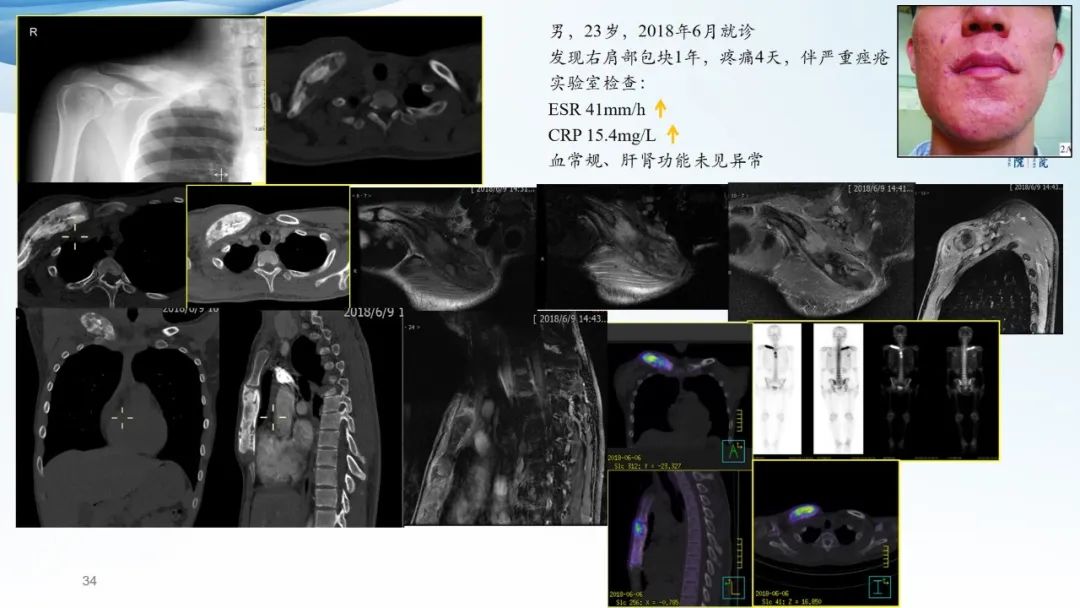 【病例】一例表现为弥漫中轴骨骨质增生硬化病变讨论-34