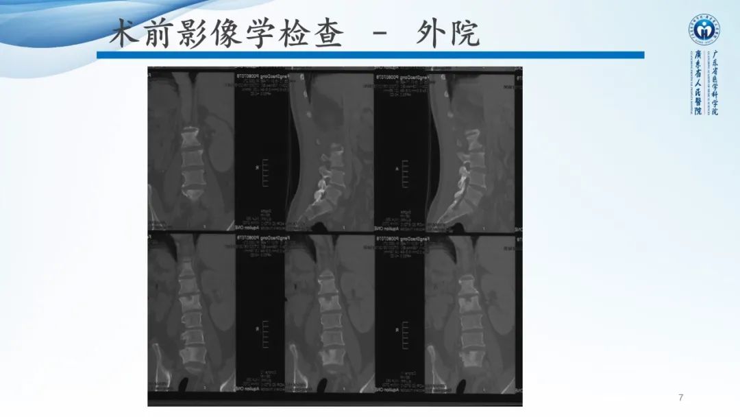 【病例】一例表现为弥漫中轴骨骨质增生硬化病变讨论-7