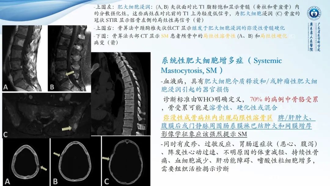 【病例】一例表现为弥漫中轴骨骨质增生硬化病变讨论-38