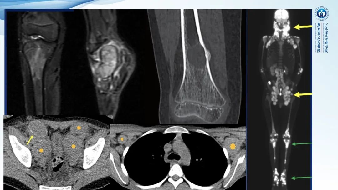 【病例】一例表现为弥漫中轴骨骨质增生硬化病变讨论-27