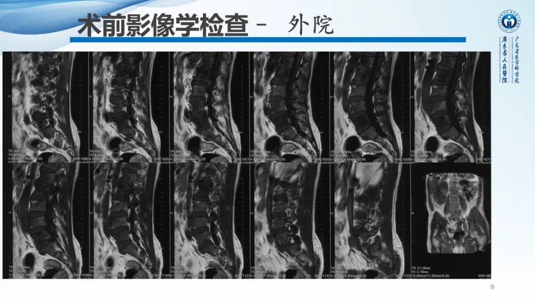【病例】一例表现为弥漫中轴骨骨质增生硬化病变讨论-9