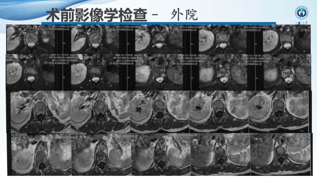 【病例】一例表现为弥漫中轴骨骨质增生硬化病变讨论-8