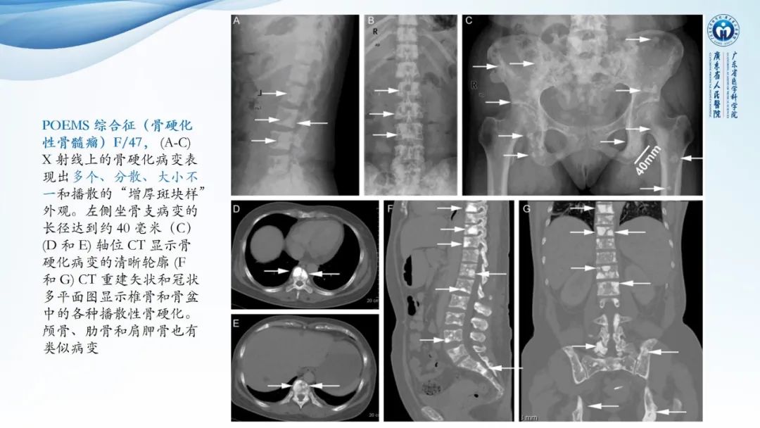 【病例】一例表现为弥漫中轴骨骨质增生硬化病变讨论-44