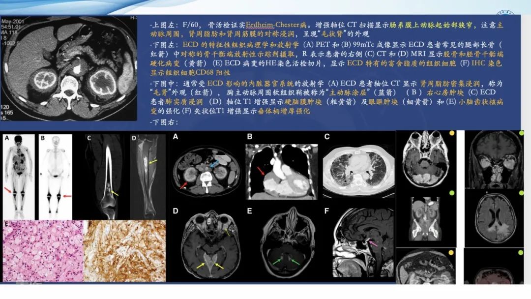 【病例】一例表现为弥漫中轴骨骨质增生硬化病变讨论-41