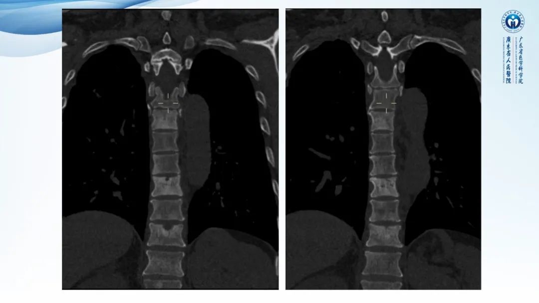 【病例】一例表现为弥漫中轴骨骨质增生硬化病变讨论-12