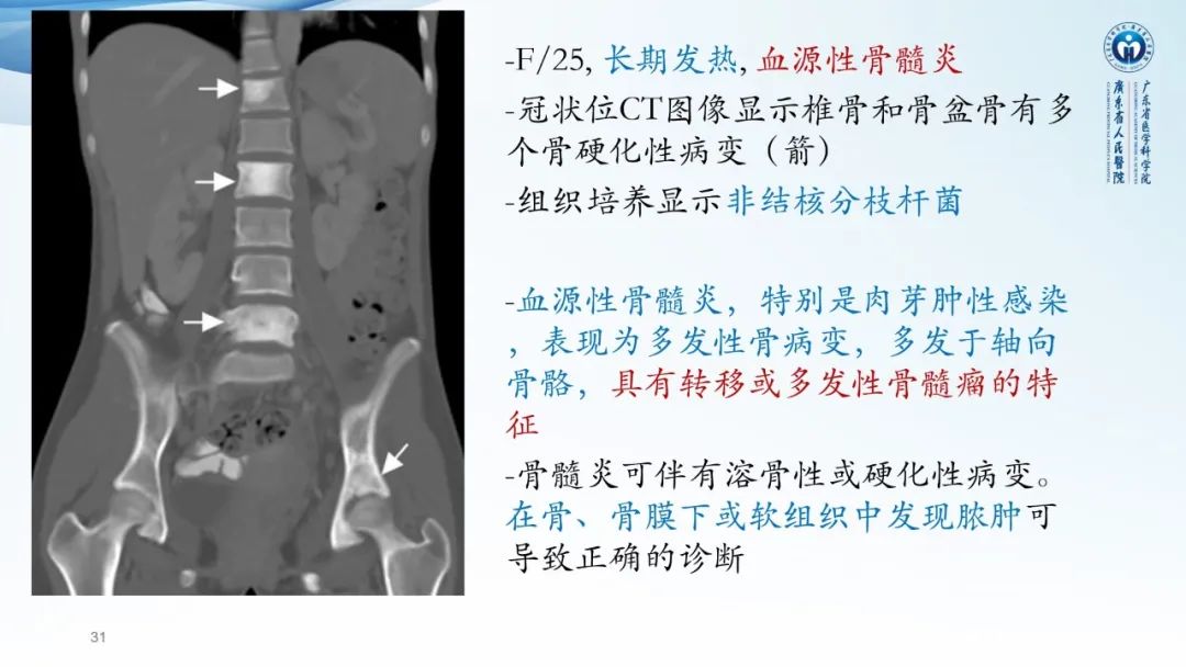 【病例】一例表现为弥漫中轴骨骨质增生硬化病变讨论-31