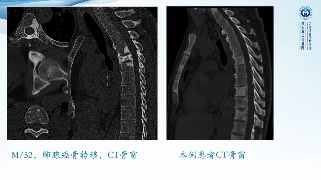 【病例】一例表现为弥漫中轴骨骨质增生硬化病变讨论-22
