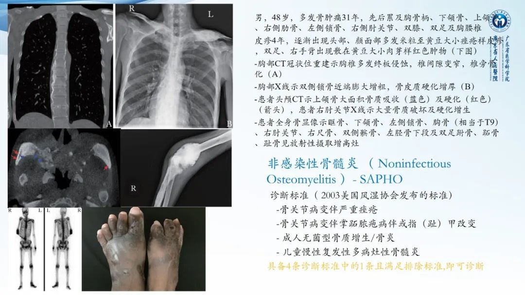 【病例】一例表现为弥漫中轴骨骨质增生硬化病变讨论-36