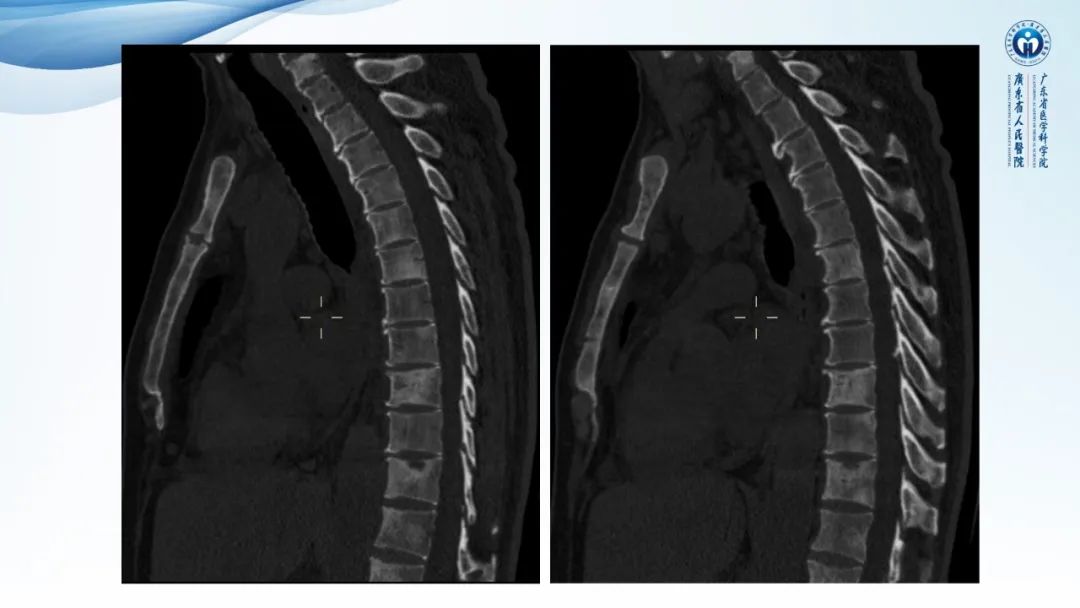 【病例】一例表现为弥漫中轴骨骨质增生硬化病变讨论-11