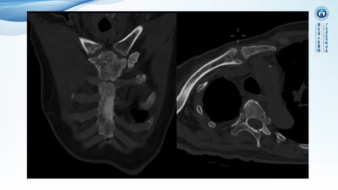 【病例】一例表现为弥漫中轴骨骨质增生硬化病变讨论-13