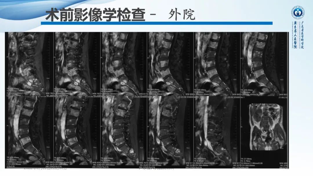 【病例】一例表现为弥漫中轴骨骨质增生硬化病变讨论-10