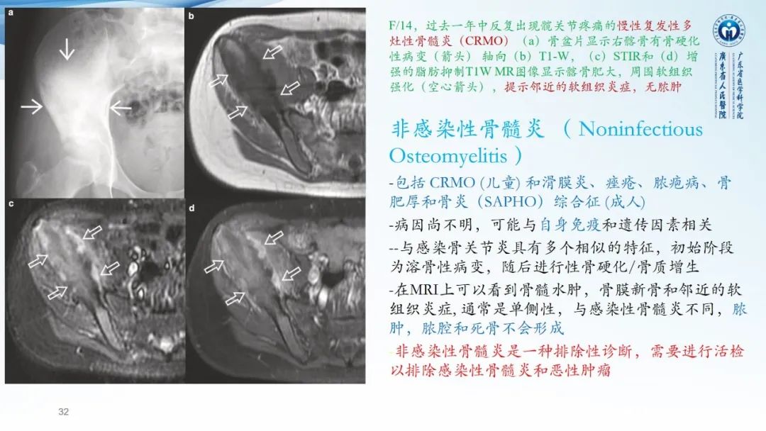 【病例】一例表现为弥漫中轴骨骨质增生硬化病变讨论-32