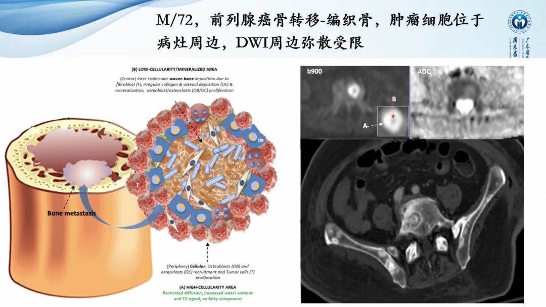 【病例】一例表现为弥漫中轴骨骨质增生硬化病变讨论-23