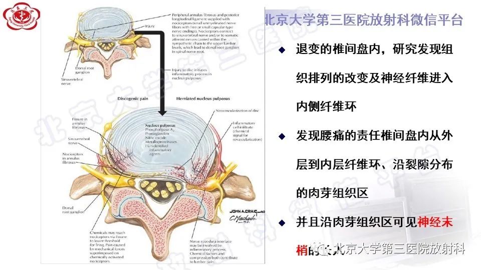 【PPT】CT引导下介入技术在脊柱退行性疾病诊疗中的应用-23