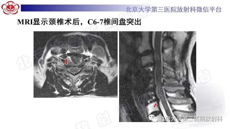 【PPT】CT引导下介入技术在脊柱退行性疾病诊疗中的应用-4