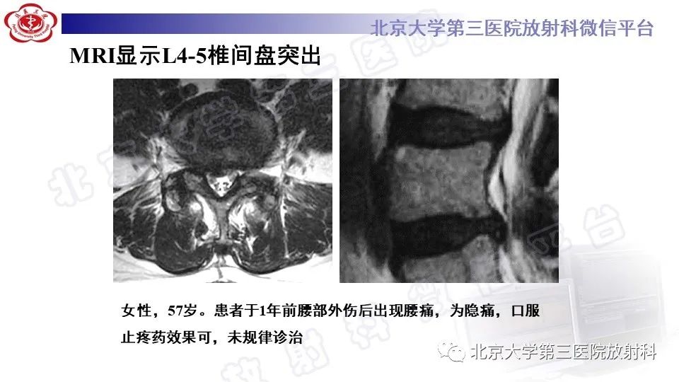 【PPT】CT引导下介入技术在脊柱退行性疾病诊疗中的应用-32