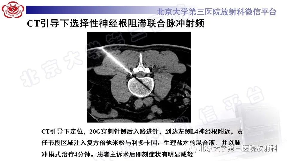 【PPT】CT引导下介入技术在脊柱退行性疾病诊疗中的应用-12