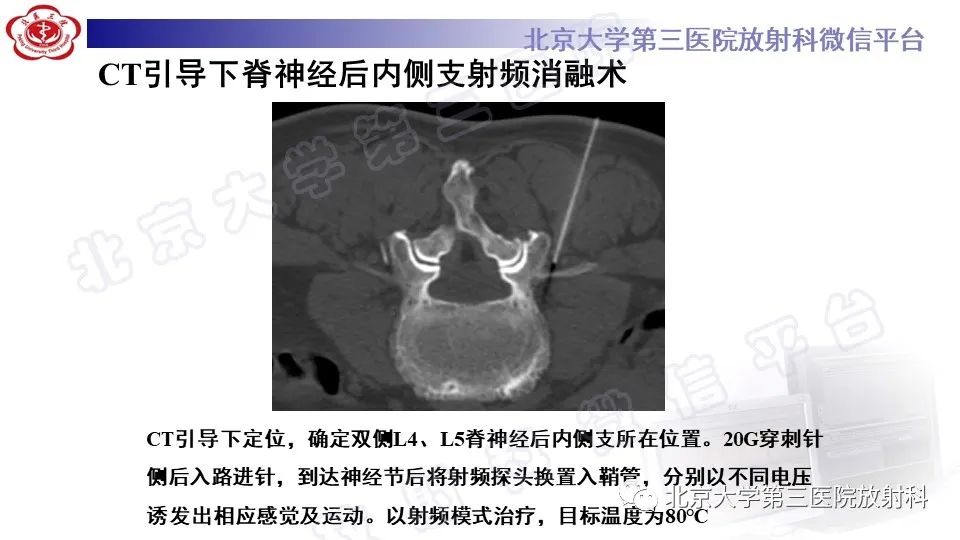 【PPT】CT引导下介入技术在脊柱退行性疾病诊疗中的应用-39
