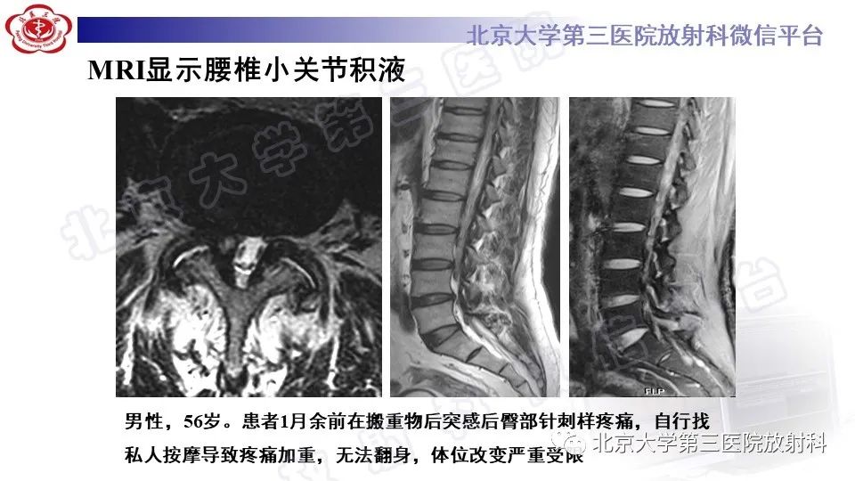 【PPT】CT引导下介入技术在脊柱退行性疾病诊疗中的应用-36