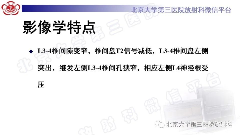 【PPT】CT引导下介入技术在脊柱退行性疾病诊疗中的应用-11