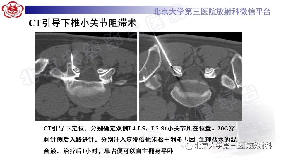 【PPT】CT引导下介入技术在脊柱退行性疾病诊疗中的应用-37
