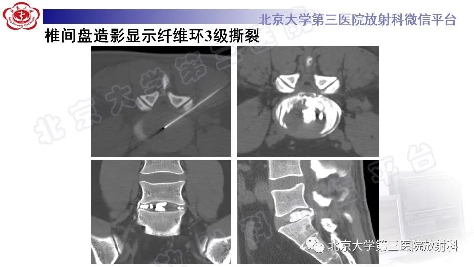 【PPT】CT引导下介入技术在脊柱退行性疾病诊疗中的应用-31