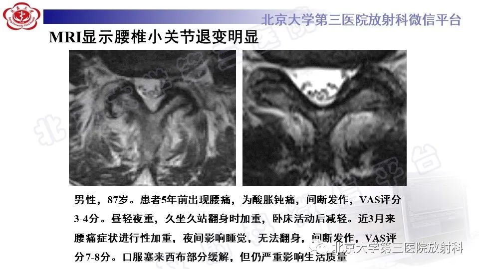 【PPT】CT引导下介入技术在脊柱退行性疾病诊疗中的应用-38