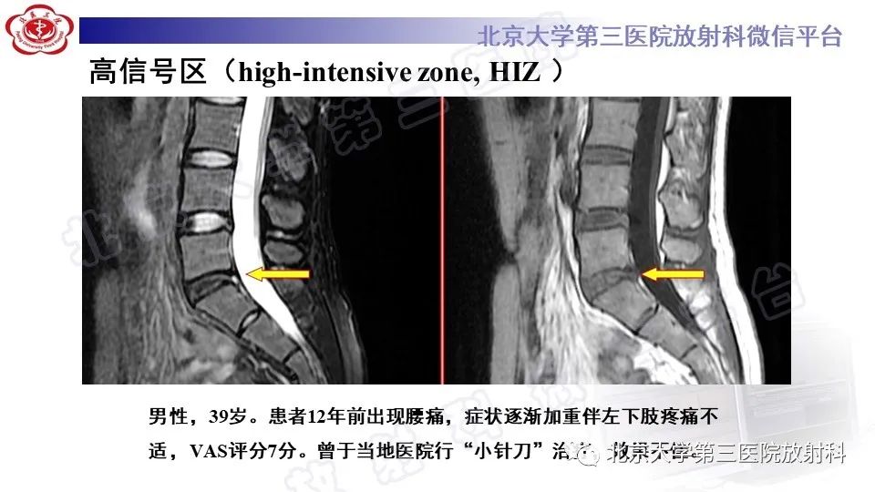 【PPT】CT引导下介入技术在脊柱退行性疾病诊疗中的应用-30