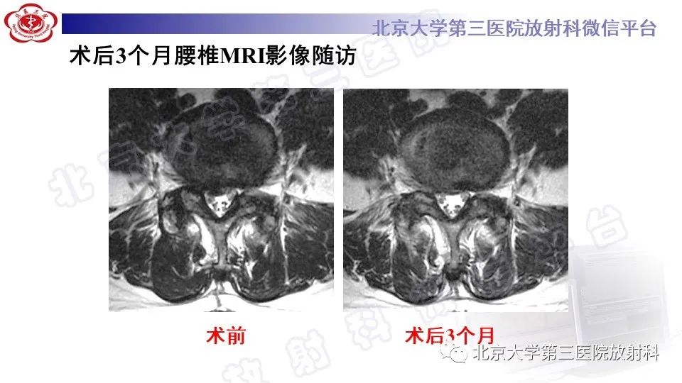 【PPT】CT引导下介入技术在脊柱退行性疾病诊疗中的应用-34
