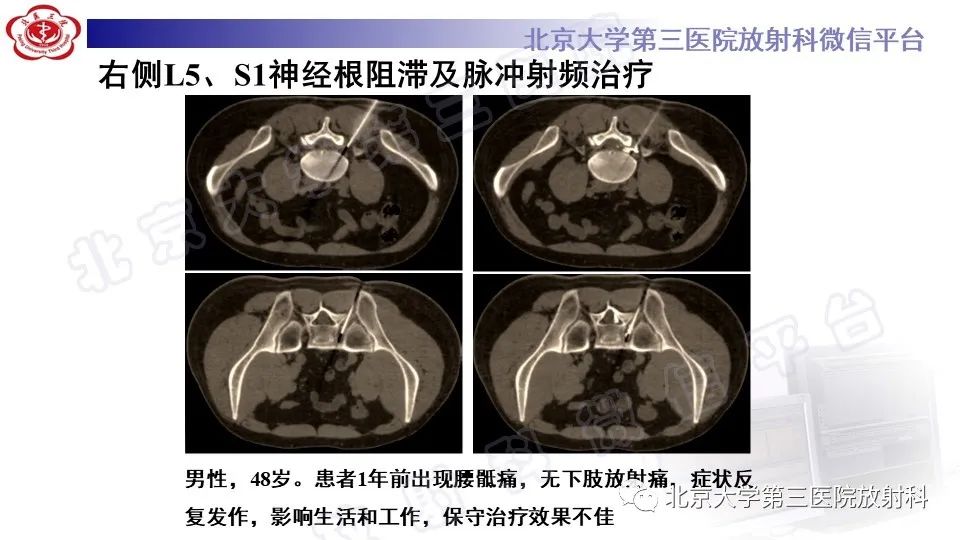 【PPT】CT引导下介入技术在脊柱退行性疾病诊疗中的应用-35