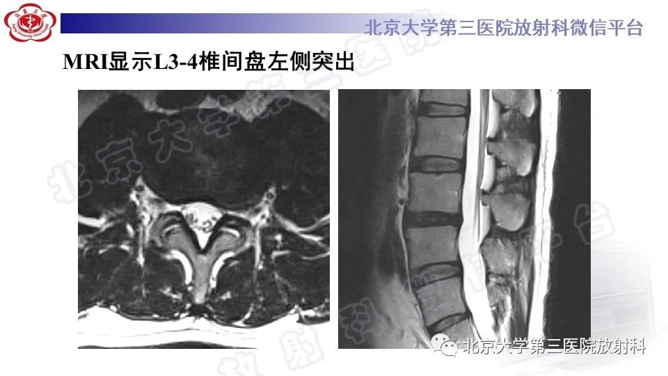 【PPT】CT引导下介入技术在脊柱退行性疾病诊疗中的应用-10