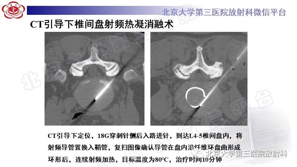 【PPT】CT引导下介入技术在脊柱退行性疾病诊疗中的应用-33