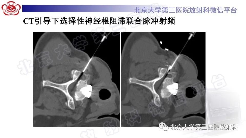 【PPT】CT引导下介入技术在脊柱退行性疾病诊疗中的应用-6